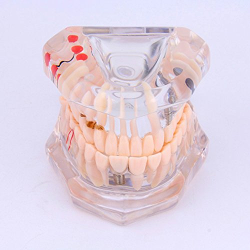 לימוד שיניים שקוף של וולפונט לימוד שיניים מודל שיניים דגם מקלע למבוגרים מודל מבחר שיניים חניכיים טיפול