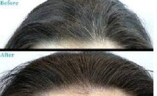 אחורה עם טבע לצמיחה מחודשת שיער טיפול ביוטין צמיחת שיער, אמלה שיער עובי ממקסם. חוסם גלולות לנשירת שיער, יבש,