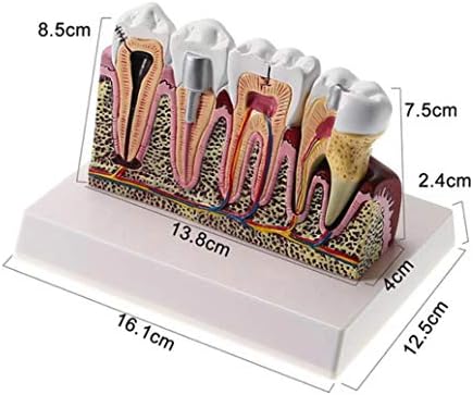 סוזאטה דגם 4 4 שיניים מחלה האנטומיה מודלים, נפוץ פתולוגיות שילוב מודלים, נשלף שן לטיפול אוראלי, חינוך והוראה